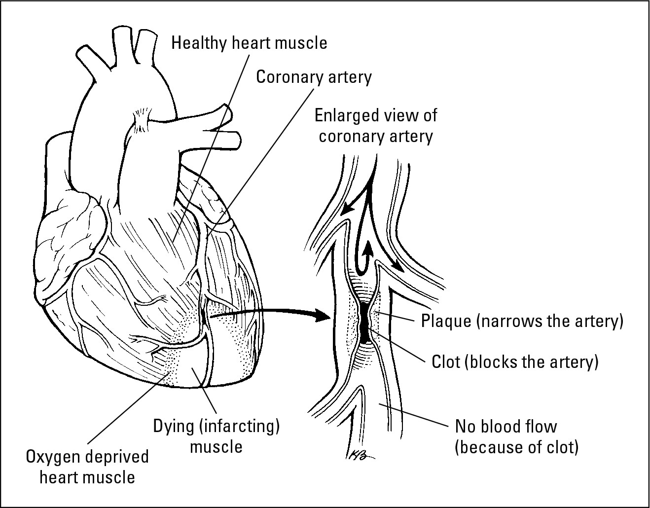 Figure 6-2: The thing to look at is the clog on the right. Your heart shouldn’t look like this.